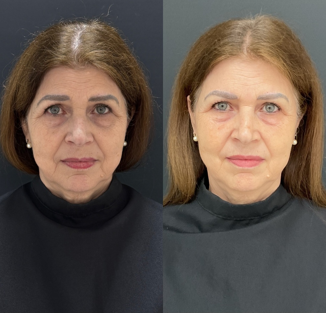 Lift Bio Cell - Clínica DYVARE